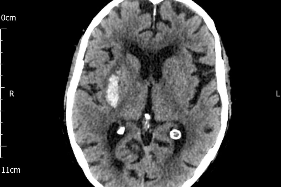 A CT scan of the brain